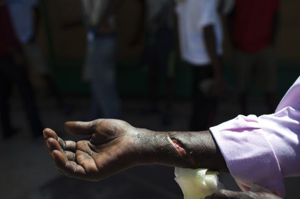 Mamadou, de Mali, muestra la herida que se hizo tratando de saltar la valla de Melilla desde Marruecos, 2013 | Foto: Ángel Navarrete
